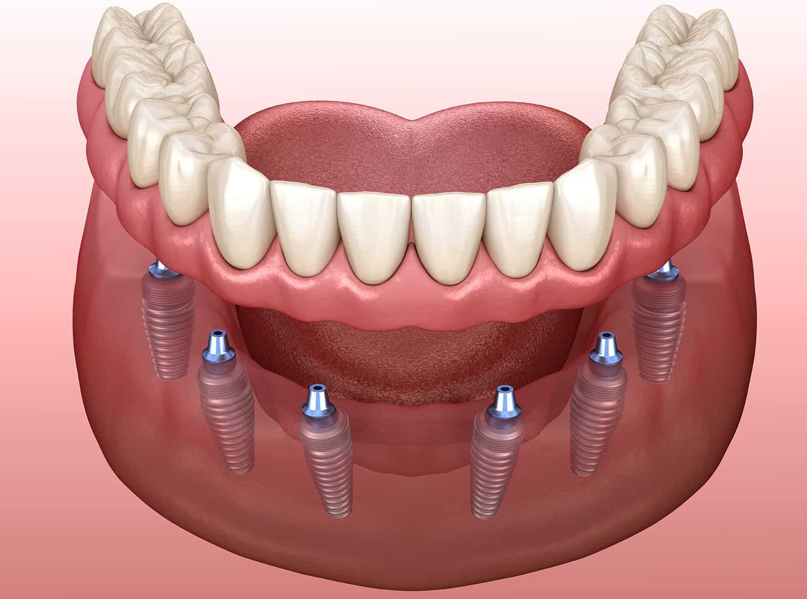 All-on-X 3D model