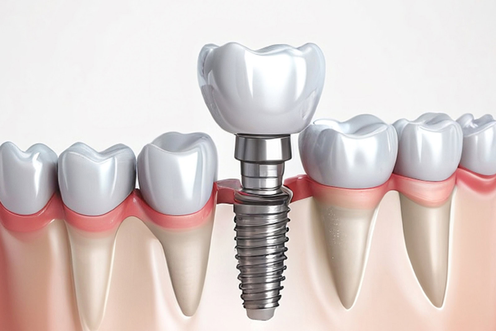 A 3D model of a dental implant