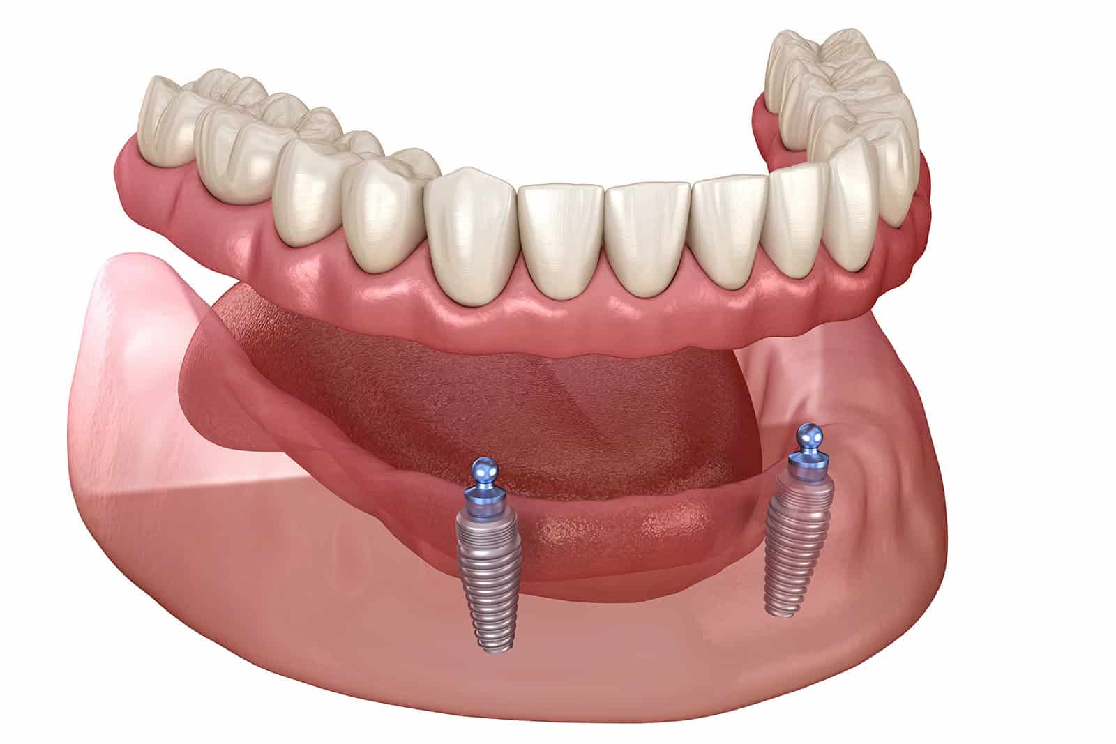 Snap-on denture model