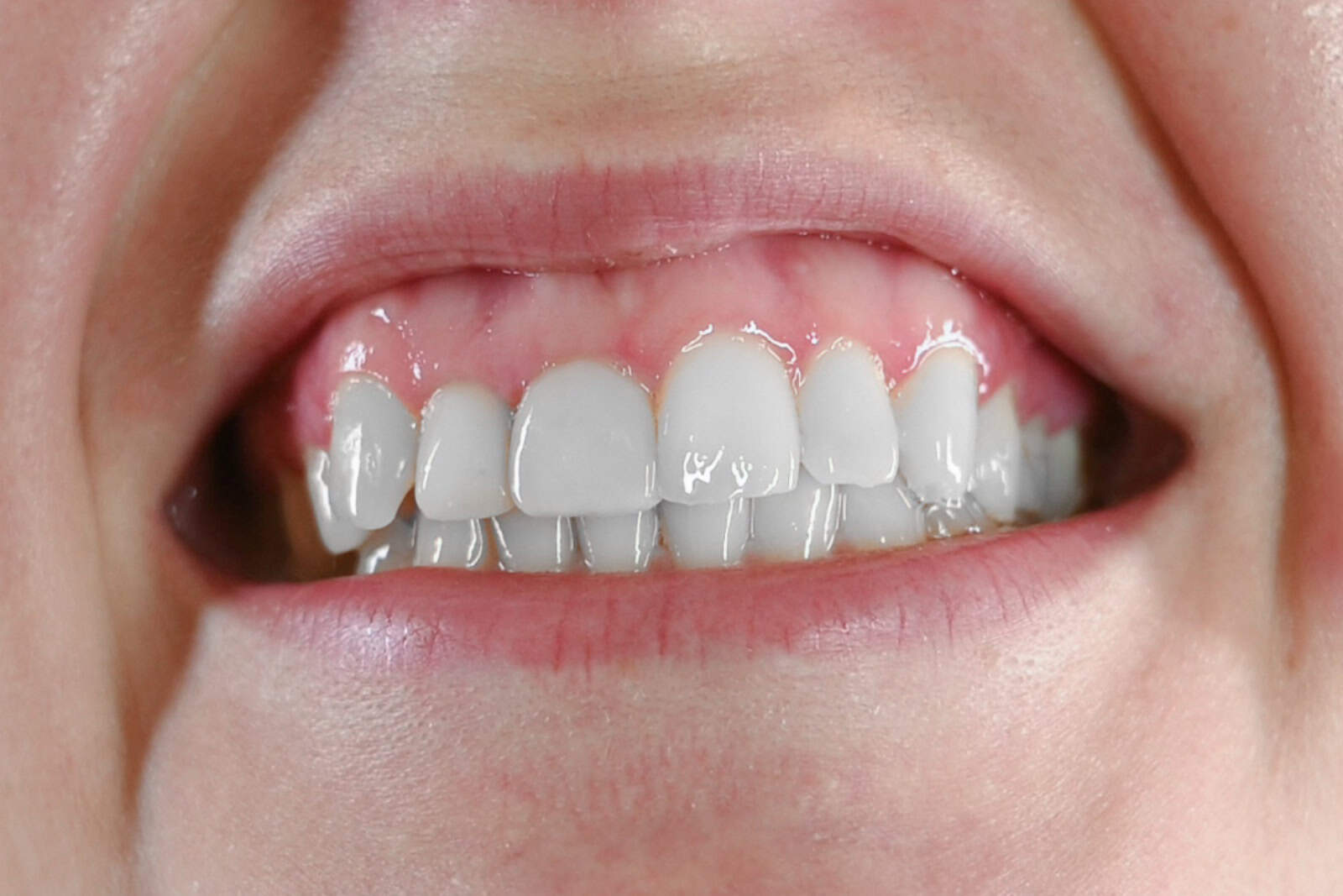 Close-up of uneven gumline and teeth